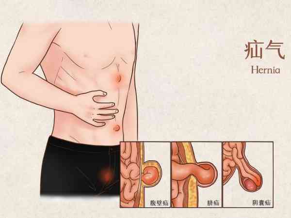 疝氣最怕三種食物是什麼