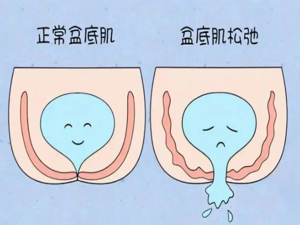 為什麼醫院不建議做盆底肌修復