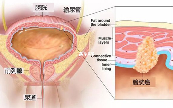 膀胱癌