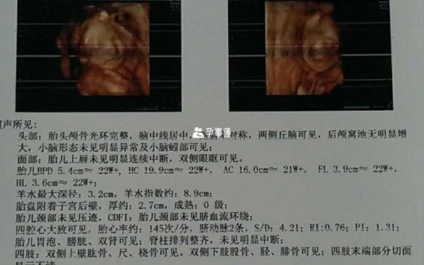 四維彩超檢查