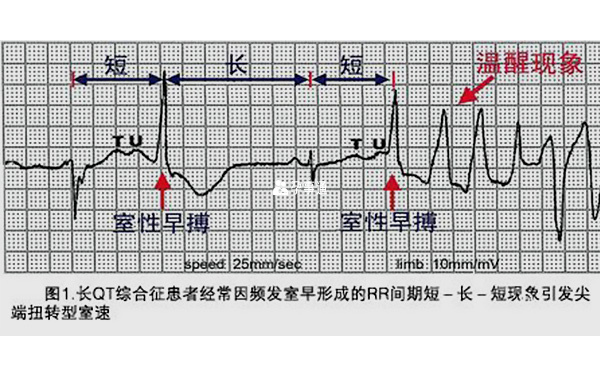 遺傳性LQTS心率失常