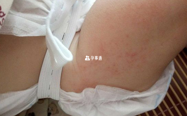 尿布疹