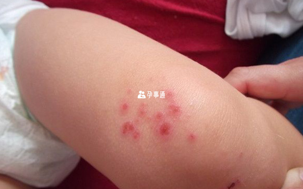 丘疹