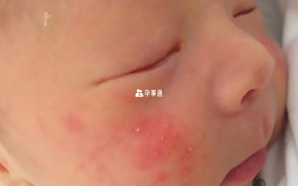 嬰兒溼疹