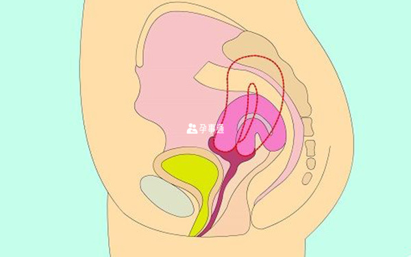 子宮後位