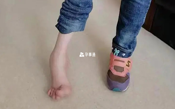 成骨不全症患者