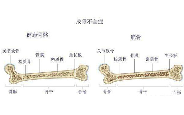 成骨不全症的症狀