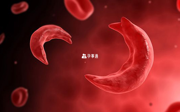 鐮刀型細胞貧血病