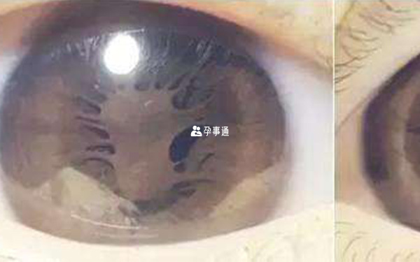 先天性無虹膜暫無治療方法
