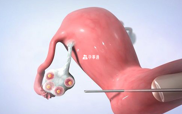 改善子宮條件能提高成功率