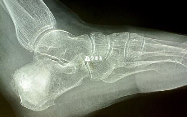 部分TRPS II患者有軟骨瘤併發症