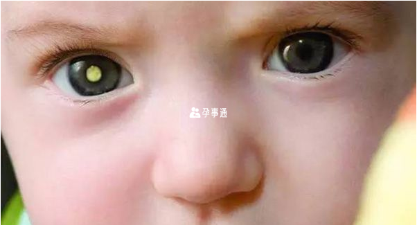 三分之一視網膜細胞瘤可以遺傳