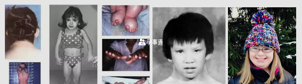 特納氏綜合症女孩照片