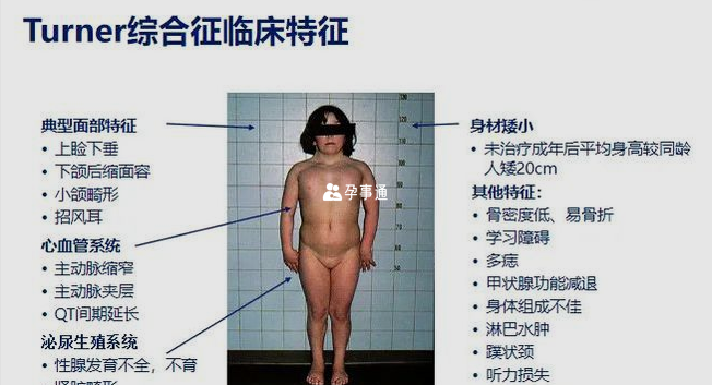 性腺發育不良 (xo型,特納氏綜合症)