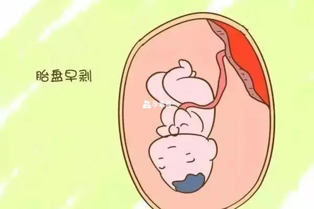 孕婦如何判斷自己是否胎盤早剝