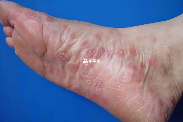 通過症狀自檢梅毒