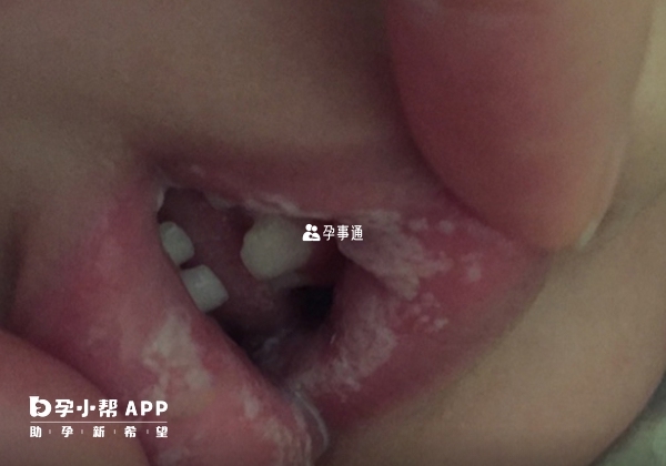 嬰兒出現鵝口瘡早期沒有痛感