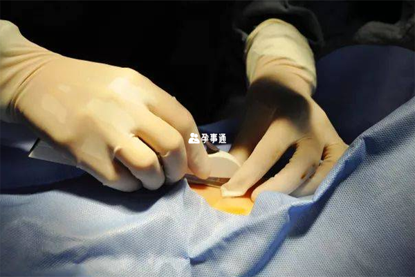 為什麼醫生建議上環不皮埋