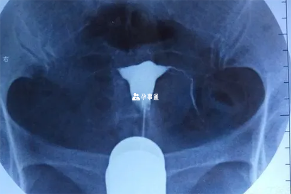 正常輸卵管會微垂從而更容易獲取卵子