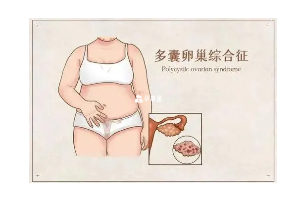 多囊女性懷孕方法介紹