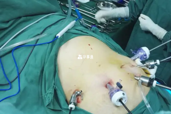 腹腔鏡手術治療多囊需通過打孔形式治療
