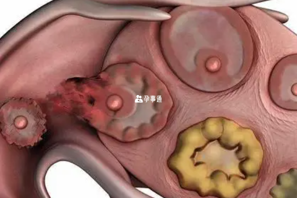 多囊卵巢女性排卵期計算方法分享
