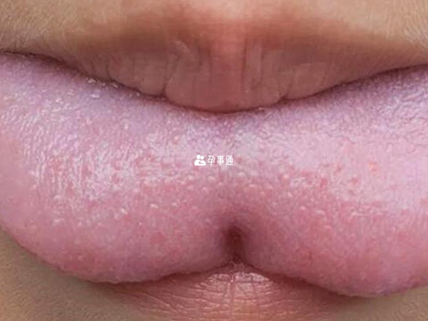 嬰兒舌繫帶短的處理方法分分享