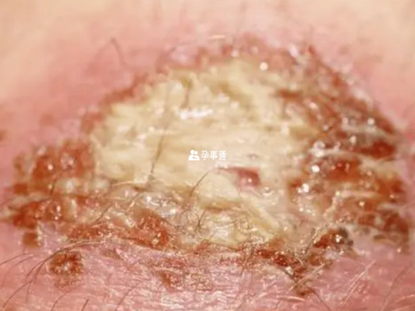 傷口發炎要怎麼辦解析