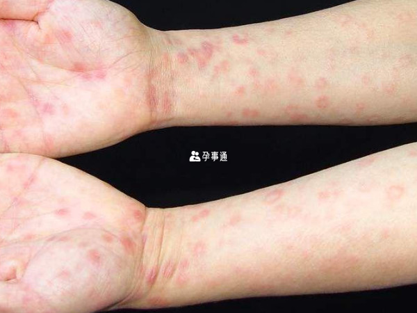 女性得了性疾病的症狀一覽