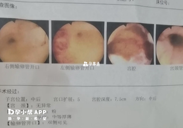 有不孕情況時就可查宮腔鏡