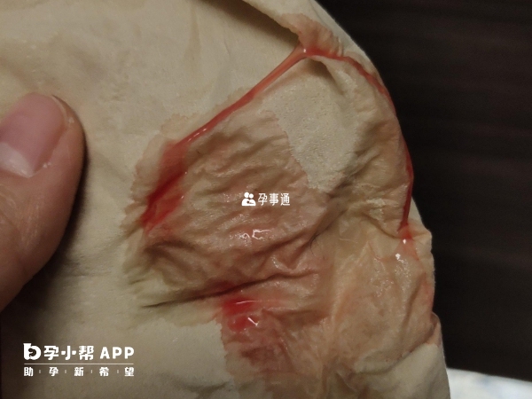 典型的著床出血圖片
