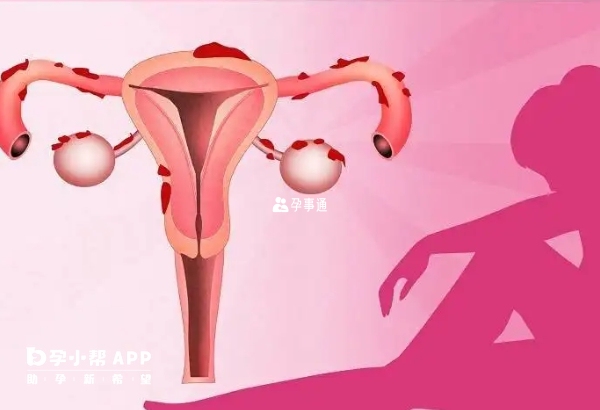 子宮內膜異位症是可以做試管的
