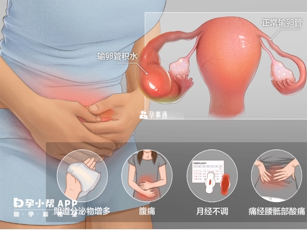 輸卵管積水只有做試管懷孕