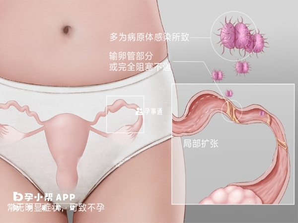 輸卵管堵塞會影響正常懷孕