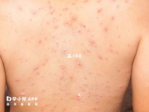 梅毒可以做試管懷孕