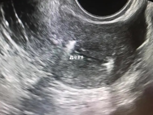 宮腔積液怎麼辦