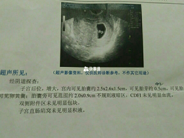 通過胎囊形狀判斷男女的方法不準