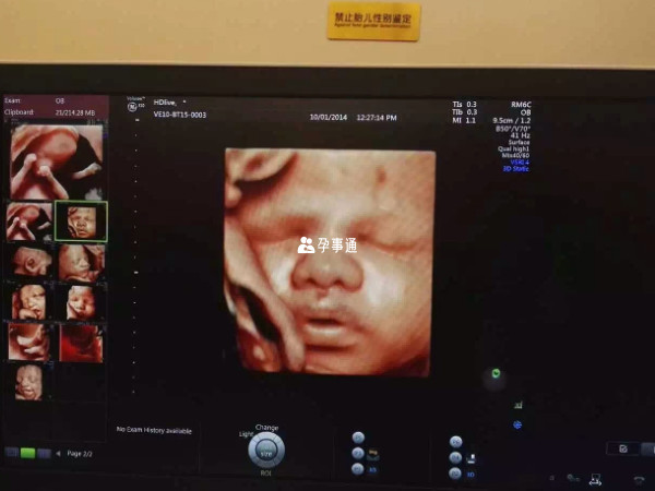 哪些人適合做四維彩超