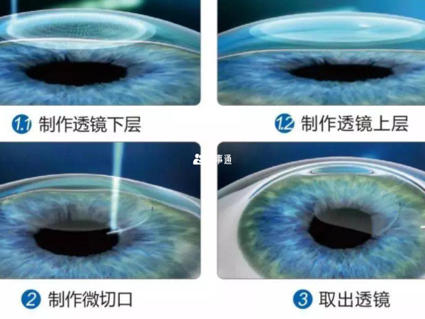 什麼情況不能做近視手術