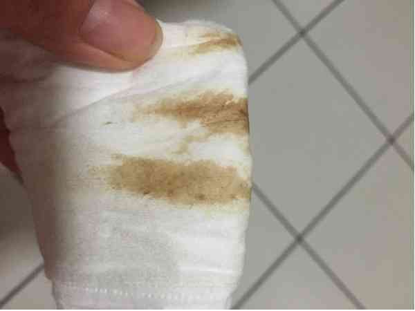 移植第二天囊胚流出來圖文詳解